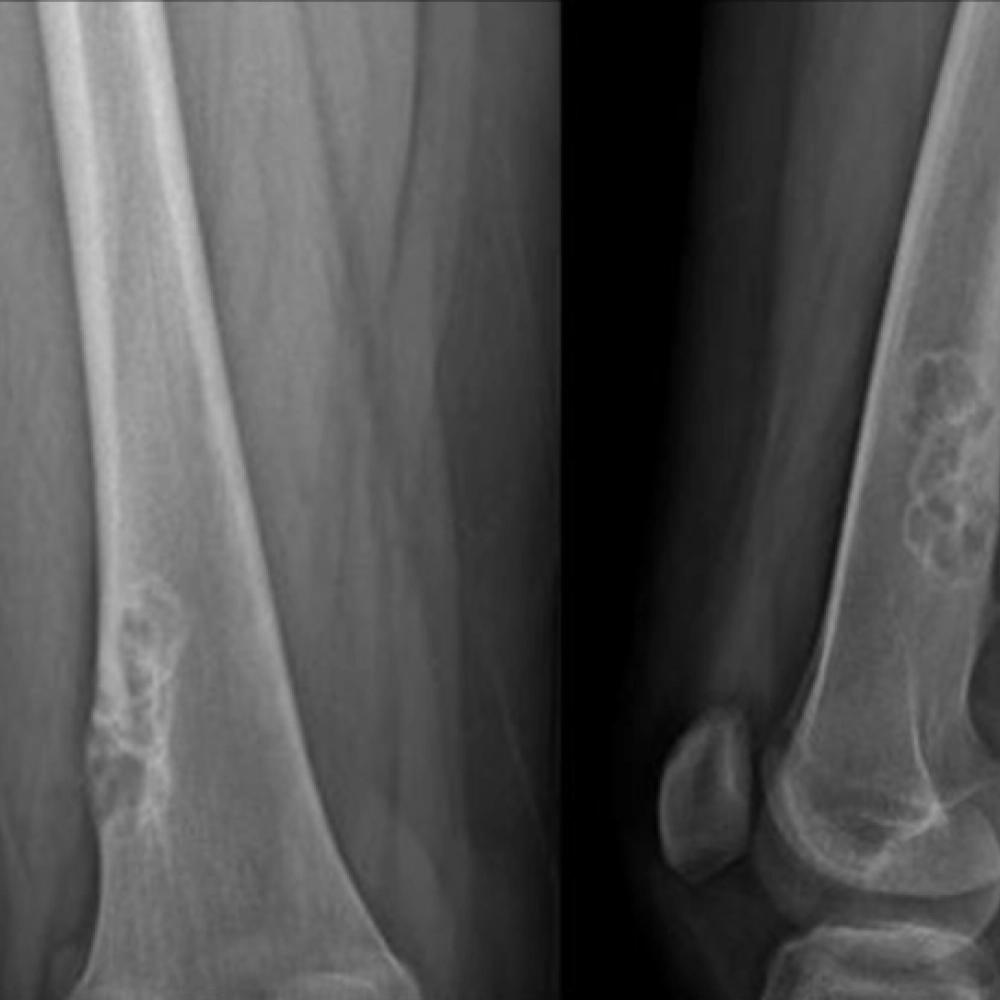 Non Ossifying Fibroma