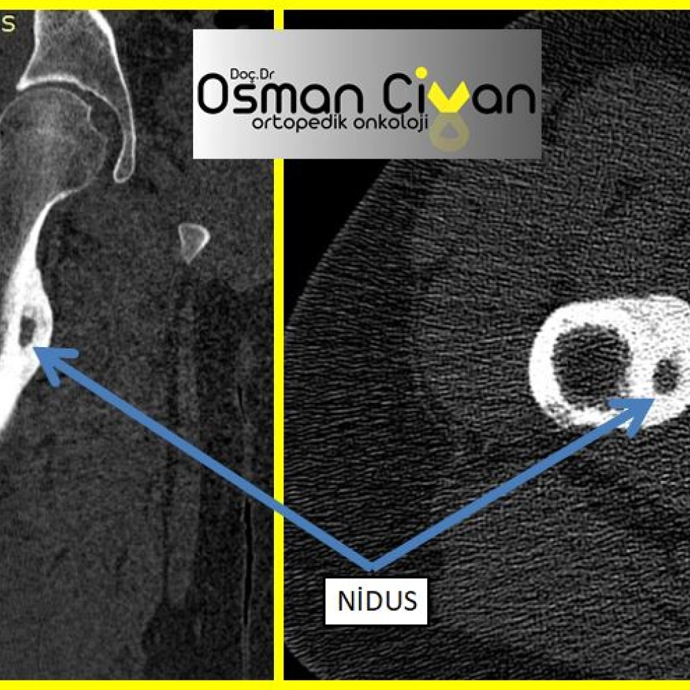 Osteoid Osteoma